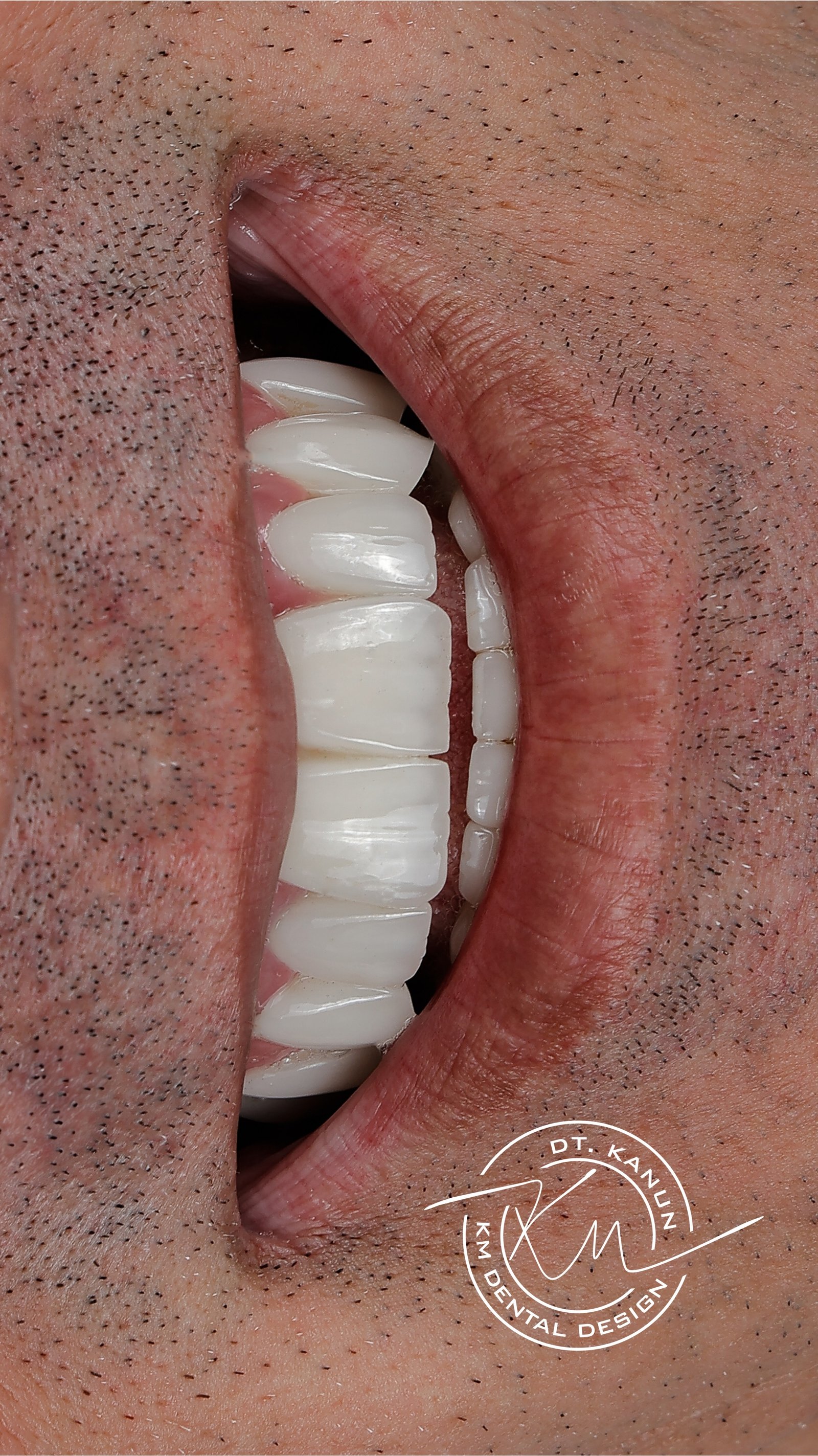 KM Dental Design - Before After 4